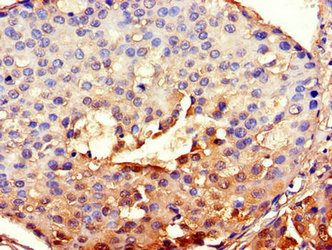 Immunohistochemistry of paraffin-embedded human breast cancer using the antibody at dilution of 1:100