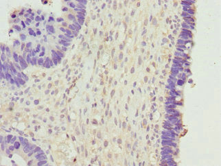 Immunohistochemistry of paraffin-embedded human ovarian cancer using BPGM Antibody at dilution of 1:100