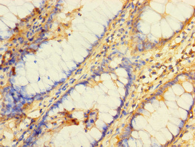 Immunohistochemistry of paraffin-embedded human colon tissue using BRCC3 Antibody at dilution of 1:100