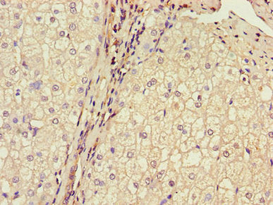 Immunohistochemistry of paraffin-embedded human liver cancer using MPC2 Antibody at dilution of 1:100Rabbit anti-Human MPC2 Polyclonal Antibody