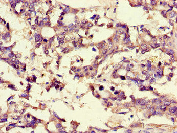 Immunohistochemistry of paraffin-embedded human gastric cancer using MPC2 Antibody at dilution of 1:100Rabbit anti-Human MPC2 Polyclonal Antibody
