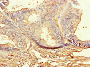 Immunohistochemistry of paraffin-embedded human endometrial cancer using the antibody at dilution of 1:100