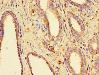 Immunohistochemistry of paraffin-embedded human prostate cancer using BUB3 Antibody at dilution of 1:100