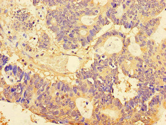Immunohistochemistry of paraffin-embedded human colon cancer using BUB3 Antibody at dilution of 1:100