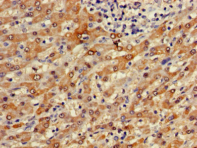 Immunohistochemistry of paraffin-embedded human liver cancer using the antibody at dilution of 1:100Rabbit anti-Human FUOM Polyclonal Antibody
