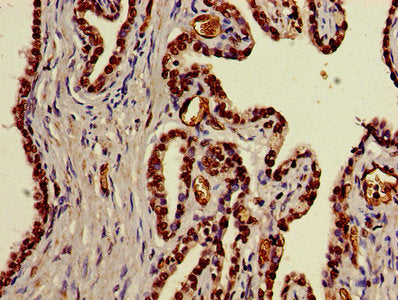 Immunohistochemistry of paraffin-embedded human prostate cancer using DDX39B Antibody at dilution of 1:100Rabbit anti-Human DDX39B Polyclonal Antibody