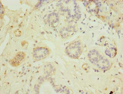 Immunohistochemistry of paraffin-embedded human breast cancer using HEATR9 Antibody at dilution of 1:100Rabbit anti-Human HEATR9 Polyclonal Antibody