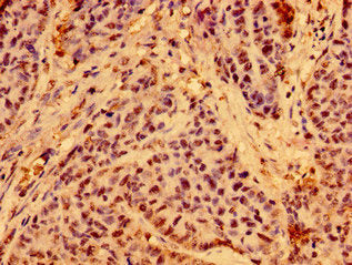 Immunohistochemistry of paraffin-embedded human ovarian cancer using C19orf12 Antibody at dilution of 1:100