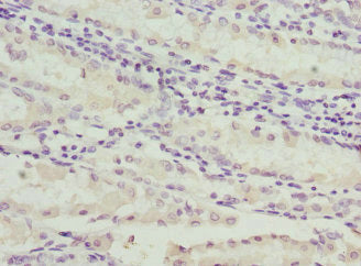Immunohistochemistry of paraffin-embedded human gastric cancer using C1GALT1C1 Antibody at dilution of 1:100