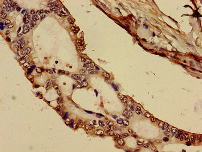 Immunohistochemistry of paraffin-embedded human pancreatic cancer using C1R Antibody at dilution of 1:100