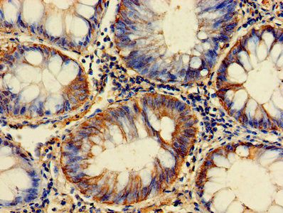 Immunohistochemistry of paraffin-embedded human colon cancer using GPI Antibody at dilution of 1:100Rabbit anti-Human GPI Polyclonal Antibody