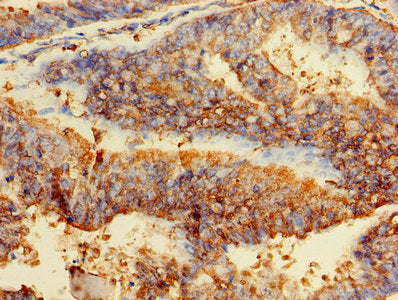 Immunohistochemistry of paraffin-embedded human endometrial cancer using GPI Antibody at dilution of 1:100Rabbit anti-Human GPI Polyclonal Antibody