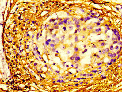 Immunohistochemistry of paraffin-embedded human breast cancer using EIF4A2 Antibody at dilution of 1:100Rabbit anti-Human EIF4A2 Polyclonal Antibody