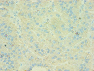 Immunohistochemistry of paraffin-embedded human liver cancer using C4BPB Antibody at dilution of 1:100