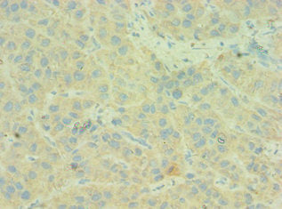 Immunohistochemistry of paraffin-embedded human liver cancer using the antibody at dilution of 1:100