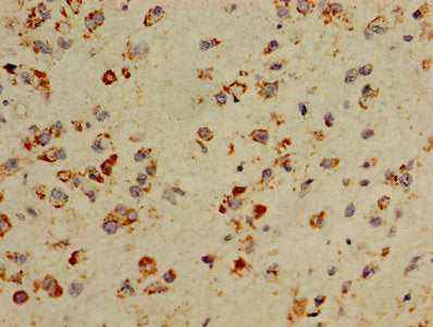 Immunohistochemistry of paraffin-embedded human glioma using COX5A Antibody at dilution of 1:100Rabbit anti-Human COX5A Polyclonal Antibody