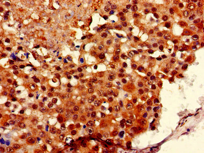 Immunohistochemistry of paraffin-embedded human breast cancer using COA1 Antibody at dilution of 1:100Rabbit anti-Human COA1 Polyclonal Antibody