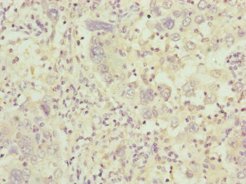 Immunohistochemistry of paraffin-embedded human liver cancer using C8B Antibody at dilution of 1:100