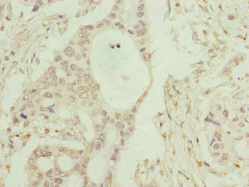 Immunohistochemistry of paraffin-embedded human pancreatic cancer using C8B Antibody at dilution of 1:100
