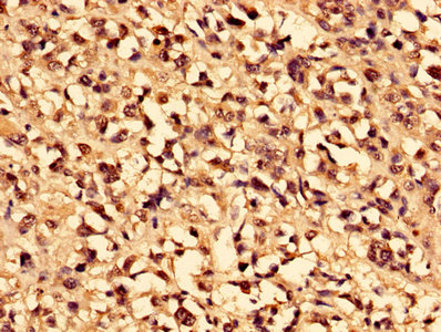 Immunohistochemistry of paraffin-embedded human melanoma using the antibody at dilution of 1:100