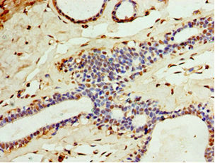 Immunohistochemistry of paraffin-embedded human breast cancer using CA8 Antibody at dilution of 1:100
