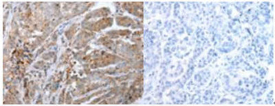 The image on the left is immunohistochemistry of paraffin-embedded Human breast cancer tissue using CALB2 Antibody at dilution 1/25, on the right is treated with synthetic peptide. (Original magnification: ×200)