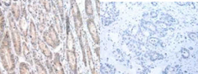 The image on the left is immunohistochemistry of paraffin-embedded Human gastric cancer tissue using CALB2 Antibody at dilution 1/25, on the right is treated with synthetic peptide. (Original magnification: ×200