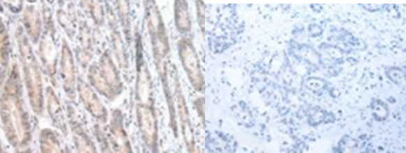 The image on the left is immunohistochemistry of paraffin-embedded Human gastric cancer tissue using CALB2 Antibody at dilution 1/25, on the right is treated with synthetic peptide. (Original magnification: ×200