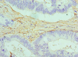 Immunohistochemistry of paraffin-embedded human colon cancer using CALD1 Antibody at dilution of 1:100