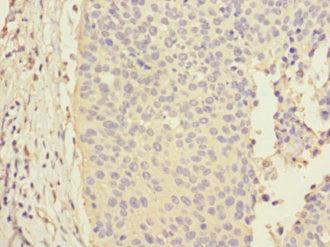 Immunohistochemistry of paraffin-embedded human cervical cancer using CALML3 Antibody at dilution of 1:100