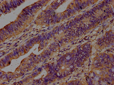 IHC image of CAP1 Antibody diluted at 1:200 and staining in paraffin-embedded human colon cancer performed on a Leica BondTM system. After dewaxing and hydration, antigen retrieval was mediated by high pressure in a citrate buffer (pH 6.0). Section was blocked with 10% normal goat serum 30min at RT. Then primary antibody (1% BSA) was incubated at 4°C overnight. The primary is detected by a biotinylated secondary antibody and visualized using an HRP conjugated SP system.