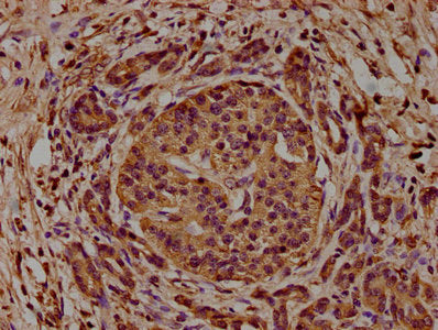 IHC image of CAP1 Antibody diluted at 1:200 and staining in paraffin-embedded human pancreatic cancer performed on a Leica BondTM system. After dewaxing and hydration, antigen retrieval was mediated by high pressure in a citrate buffer (pH 6.0). Section was blocked with 10% normal goat serum 30min at RT. Then primary antibody (1% BSA) was incubated at 4°C overnight. The primary is detected by a biotinylated secondary antibody and visualized using an HRP conjugated SP system.