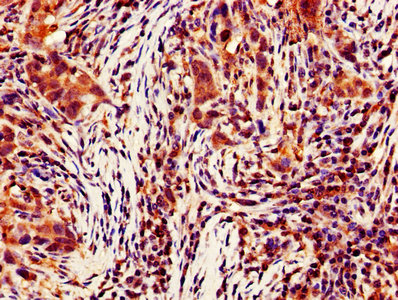 IHC image of CASP4 Antibody diluted at 1:700 and staining in paraffin-embedded human pancreatic cancer performed on a Leica BondTM system. After dewaxing and hydration, antigen retrieval was mediated by high pressure in a citrate buffer (pH 6.0). Section was blocked with 10% normal goat serum 30min at RT. Then primary antibody (1% BSA) was incubated at 4°C overnight. The primary is detected by a biotinylated secondary antibody and visualized using an HRP conjugated SP system.