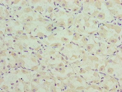 Immunohistochemistry of paraffin-embedded human gastric cancer using CASQ1 Antibody at dilution of 1:100