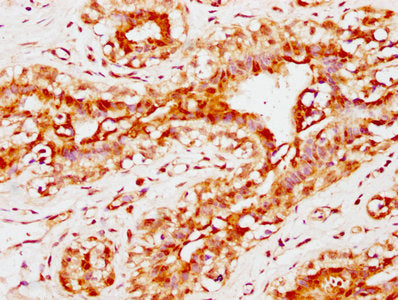 IHC image of the antibody diluted at 1:300 and staining in paraffin-embedded human breast cancer performed on a Leica BondTM system. After dewaxing and hydration, antigen retrieval was mediated by high pressure in a citrate buffer (pH 6.0). Section was blocked with 10% normal goat serum 30min at RT. Then primary antibody (1% BSA) was incubated at 4°C overnight. The primary is detected by a biotinylated secondary antibody and visualized using an HRP conjugated SP system.