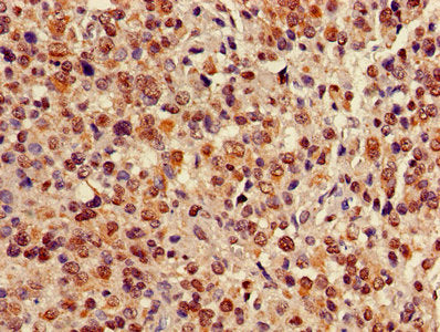 Immunohistochemistry of paraffin-embedded human glioma using CBX5 Antibody at dilution of 1:100