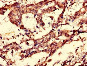 Immunohistochemistry of paraffin-embedded human gastric cancer using CCNC Antibody at dilution of 1:100Rabbit anti-Human CCNC Polyclonal Antibody