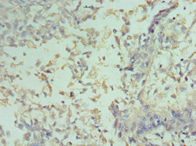 Immunohistochemistry of paraffin-embedded human cervical cancer using the antibody at dilution of 1:100