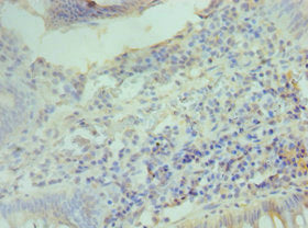 Immunohistochemistry of paraffin-embedded human colon cancer using CCND2 Antibody at dilution of 1:100Rabbit anti-Human CCND2 Polyclonal Antibody
