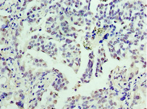 Immunohistochemistry of paraffin-embedded human lung cancer using CCND3 Antibody at dilution of 1:100Rabbit anti-Human CCND3 Polyclonal Antibody