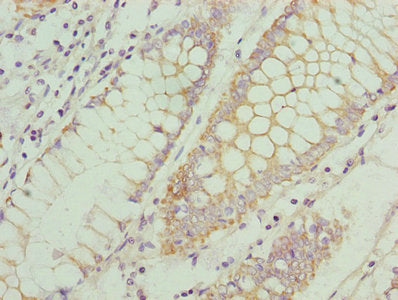 Immunohistochemistry of paraffin-embedded human colon cancer using the antibody at dilution of 1:100