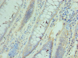 Immunohistochemistry of paraffin-embedded human colon cancer using CCT3 Antibody at dilution of 1:100Rabbit anti-Human CCT3 Polyclonal Antibody