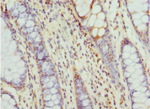Immunohistochemistry of paraffin-embedded human colon cancer using CCT5 Antibody at dilution of 1:100Rabbit anti-Human CCT5 Polyclonal Antibody