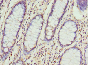 Immunohistochemistry of paraffin-embedded human colon cancer using CCT5 Antibody at dilution of 1:100Rabbit anti-Human CCT5 Polyclonal Antibody