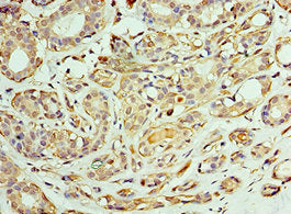 Immunohistochemistry of paraffin-embedded human breast cancer using the antibody at dilution of 1:100