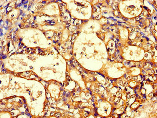 Immunohistochemistry of paraffin-embedded human gastric cancer using CCT8 Antibody at dilution of 1:100Rabbit anti-Human CCT8 Polyclonal Antibody