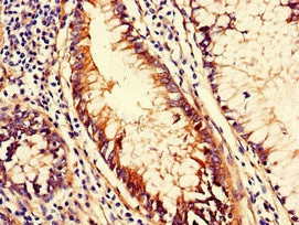Immunohistochemistry of paraffin-embedded human colon cancer using CD151 Antibody at dilution of 1:100Rabbit anti-Human CD151 Polyclonal Antibody