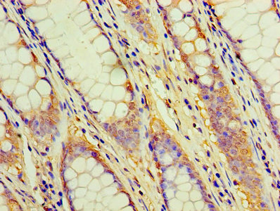 Immunohistochemistry of paraffin-embedded human colon cancer using CD2 Antibody at dilution of 1:100Rabbit anti-Human CD2 Polyclonal Antibody