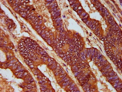 IHC image of CD2AP Antibody diluted at 1:200 and staining in paraffin-embedded human colon cancer performed on a Leica BondTM system. After dewaxing and hydration, antigen retrieval was mediated by high pressure in a citrate buffer (pH 6.0). Section was blocked with 10% normal goat serum 30min at RT. Then primary antibody (1% BSA) was incubated at 4°C overnight. The primary is detected by a biotinylated secondary antibody and visualized using an HRP conjugated SP system.Rabbit anti-Human CD2AP Polyclonal Antibody