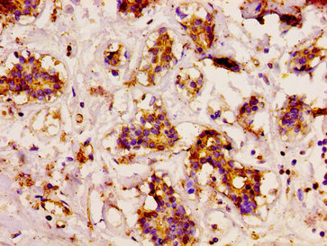 IHC image of CD3EAP Antibody diluted at 1:200 and staining in paraffin-embedded human breast cancer performed on a Leica BondTM system. After dewaxing and hydration, antigen retrieval was mediated by high pressure in a citrate buffer (pH 6.0). Section was blocked with 10% normal goat serum 30min at RT. Then primary antibody (1% BSA) was incubated at 4°C overnight. The primary is detected by a biotinylated secondary antibody and visualized using an HRP conjugated SP system.Rabbit anti-Human CD3EAP Polyclonal Antibody